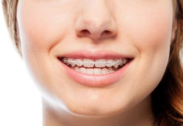 تفاوت-ارتودنسی-ثابت-و-متحرک-مرتب-کردن-دندان-با-انواع-ارتودنسی1